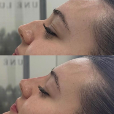 Non-Surgical Rhinoplasty before and after at Lunè Luxe