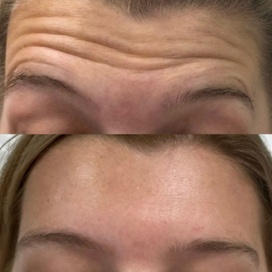 Anti-Wrinkle before and after at Lunè Luxe