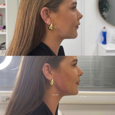 Chin & Jaw Filler before and after at Lunè Luxe