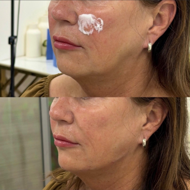 Skin Rejuvenation before and after at Lunè Luxe